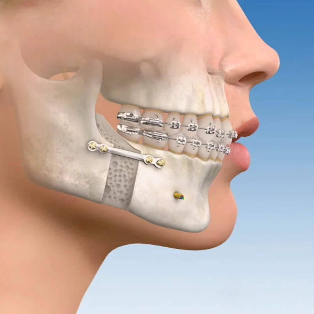 Cirurgia Ortognática